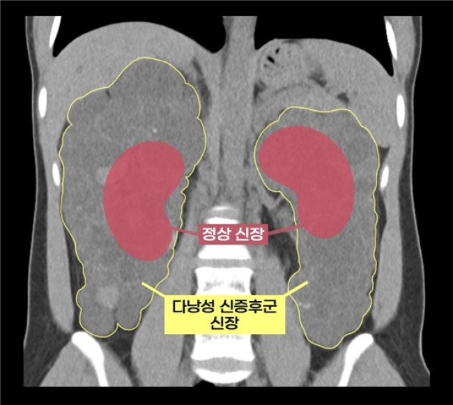 실제 다낭성 신증후군 환자의 신장과 정상 신장 비교