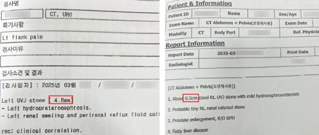 급여 삭감된 요로결석 환자들의 결석 크기 판독 기록