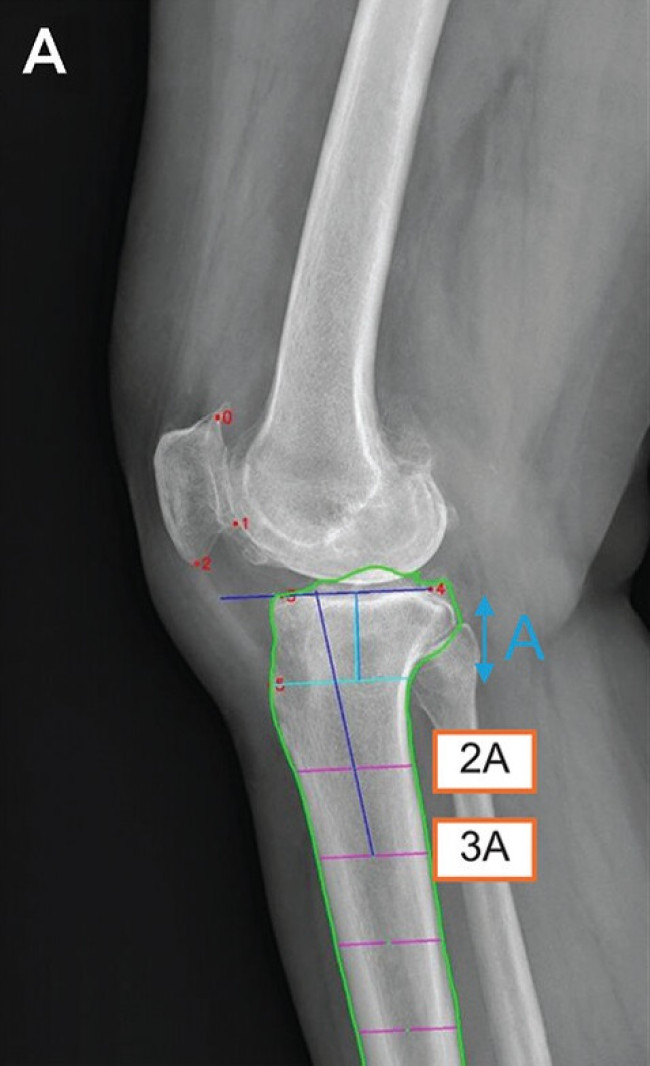 딥러닝 모델의 경골 후방 경사각 측정 메커니즘